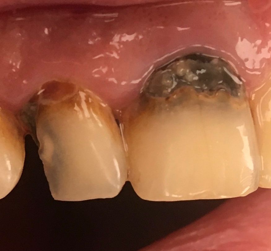 Реставрация фронтальных зубов композитными материалами